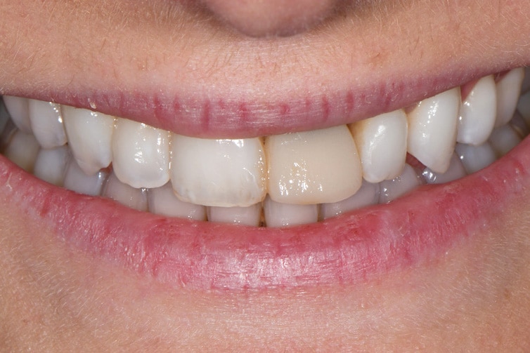 front-tooth-implant-before