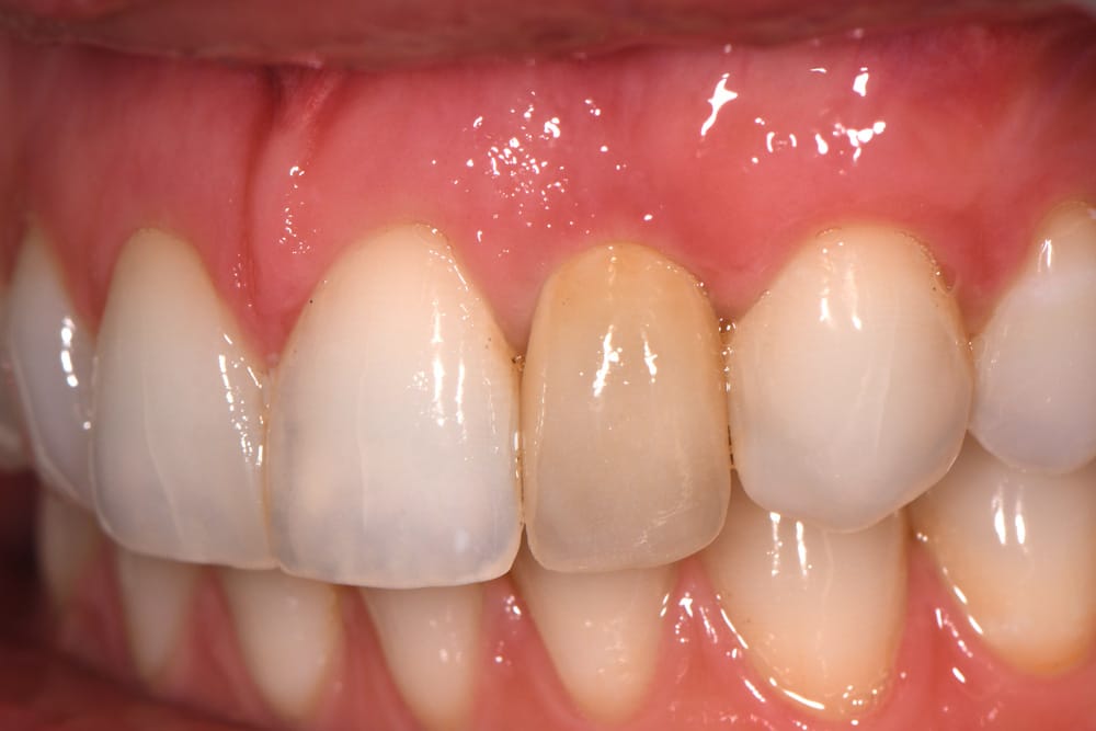 single-implant-crown-before