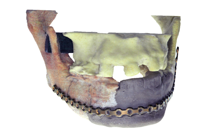 3D Printed Model of Jaw in a day Patient