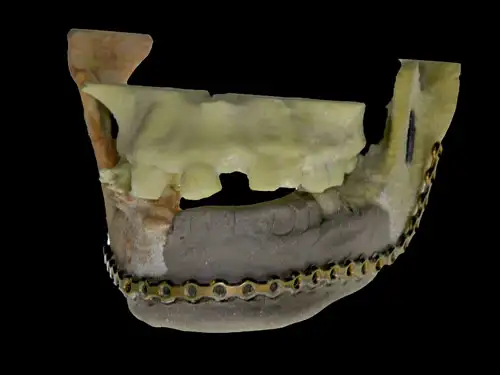 3DPrinted Jaw