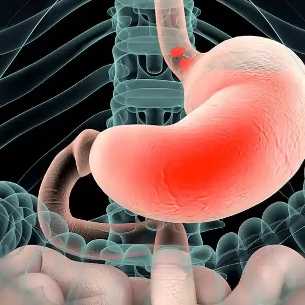 GERD and acid reflux uai