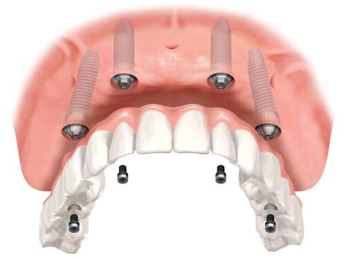 Upper and lower dental implants.