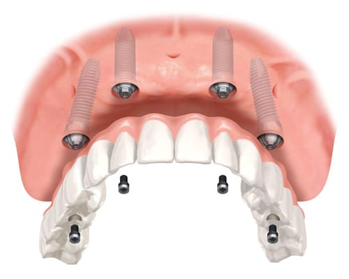 upper and lower dental implants