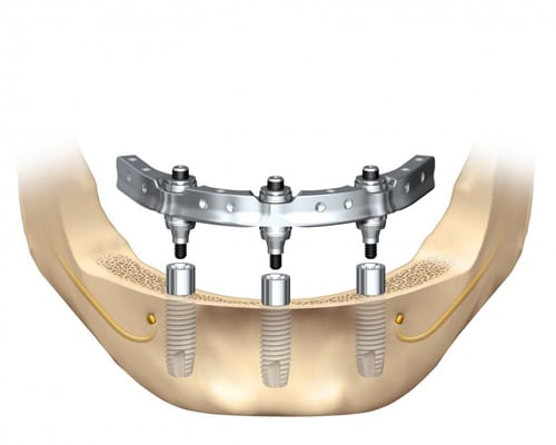 lower jaw dental implants, Trefoil