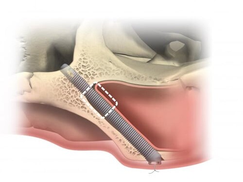 Zygomatic implants, dental implants for the upper jaw.