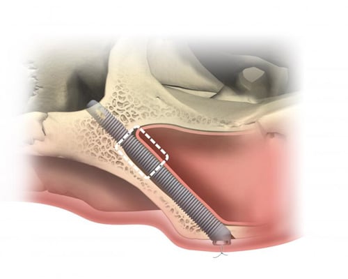 zygomatic implants, dental implants