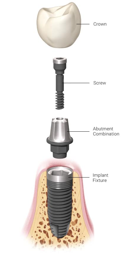 Dental Implant process