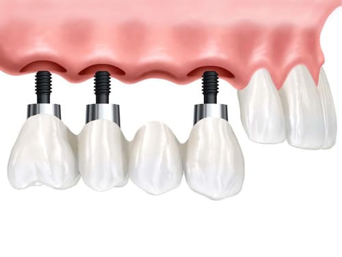 One to Three Dental Implants