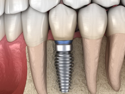 What is a Dental Implant? illustration