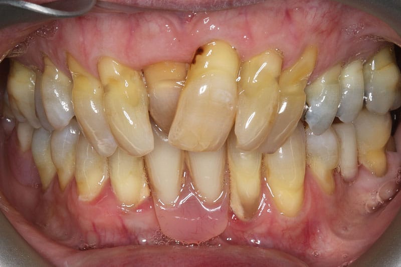 Advanced-Restorations-before-Retractor-view