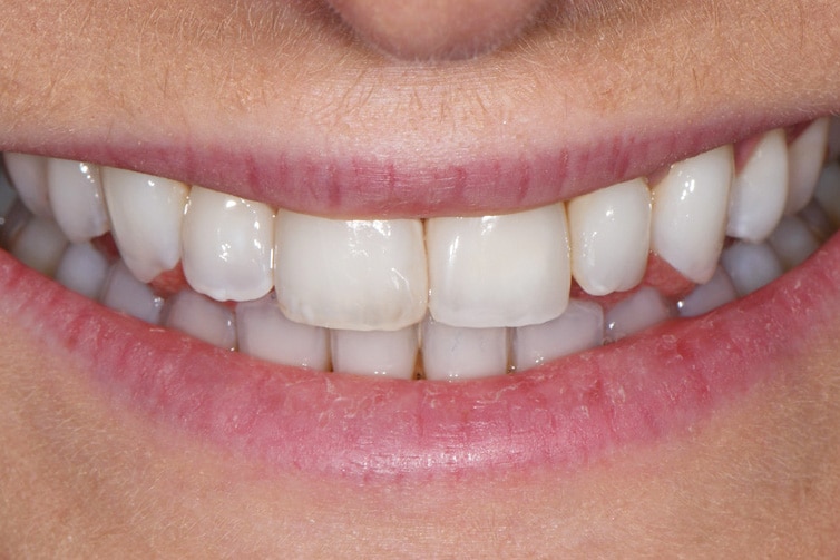 Front-tooth-implant-after