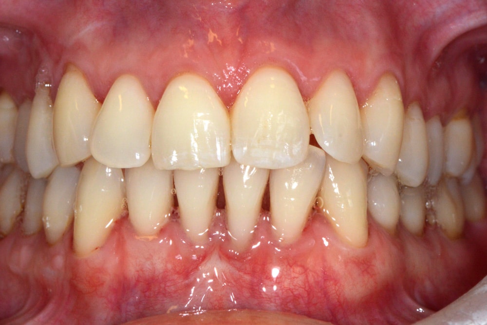 Gum-Recession-after