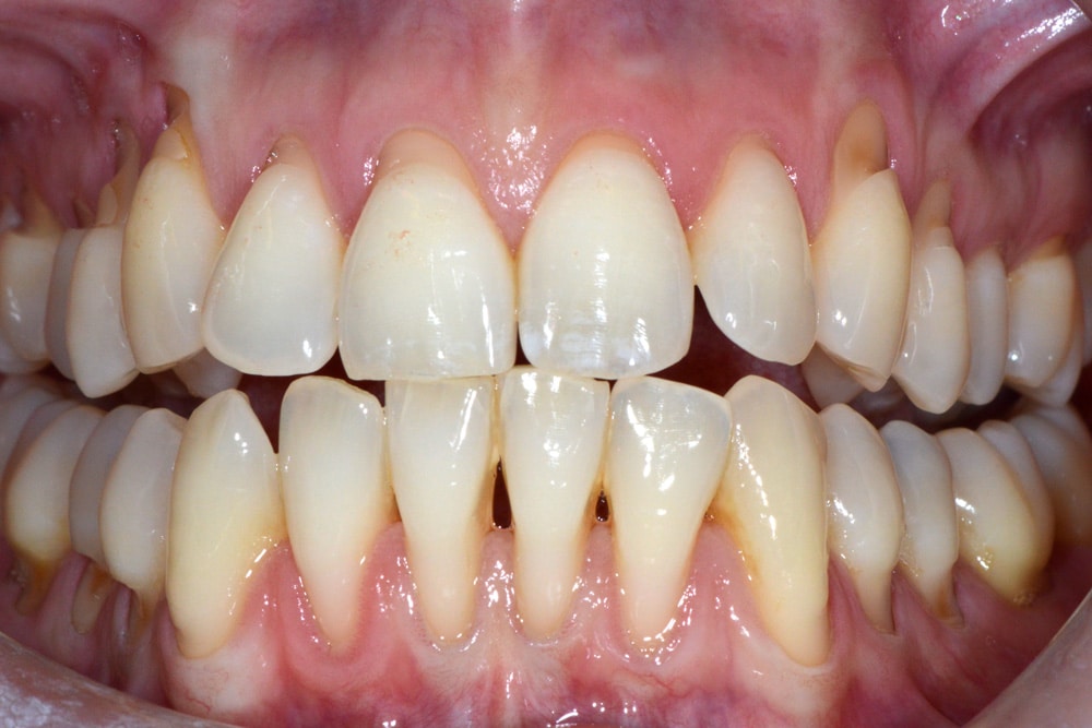 Gum-recession-before