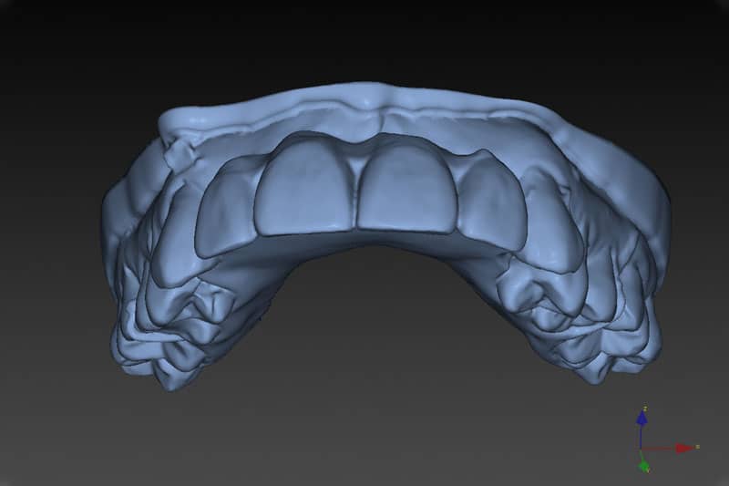 Dental Implant Planning CAD After