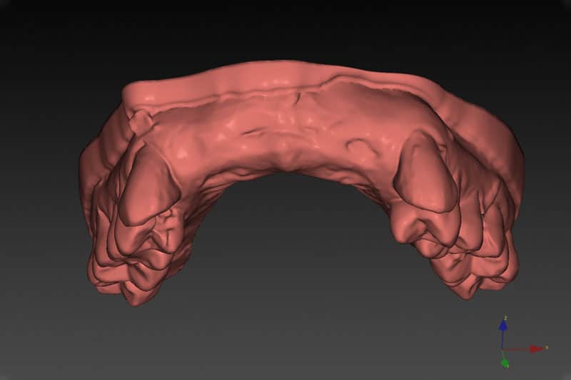 Dental Implant Planning CAD-Before