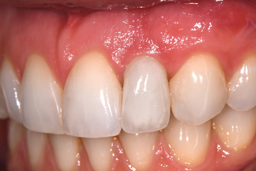 single-implant-crown-after