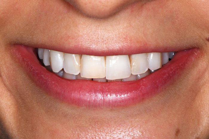 Whitening-after