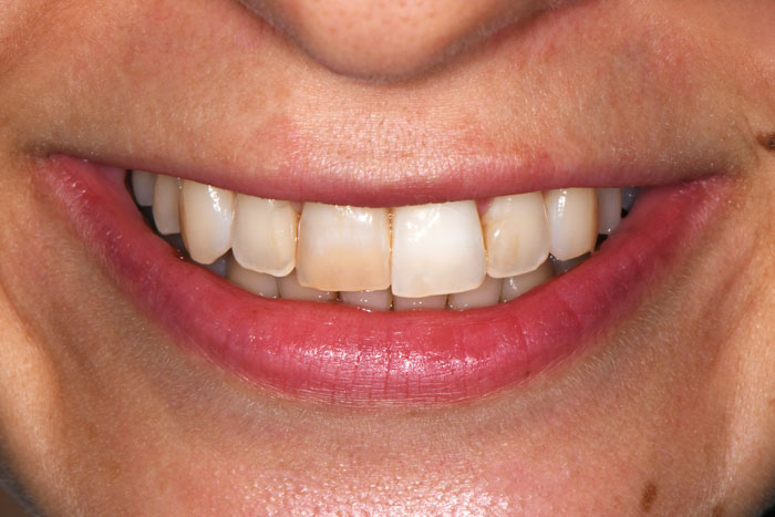 Whitening-before