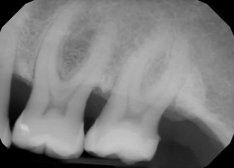 Bone Graft