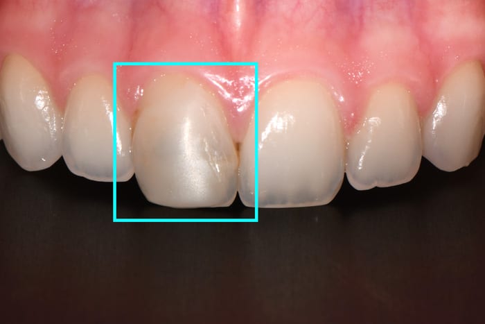 Front-tooth-Composite-bonding-before