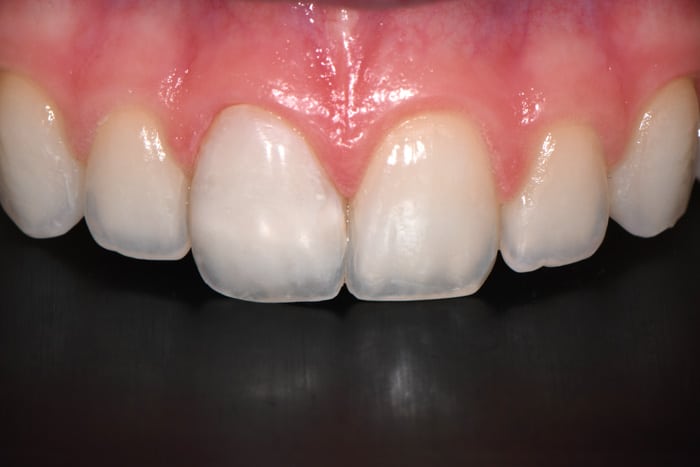 Front-tooth-composite-bonding-after