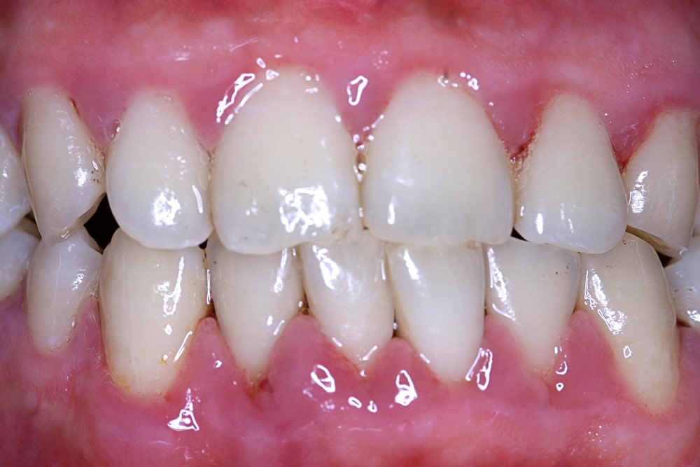 Gingivitis-Before