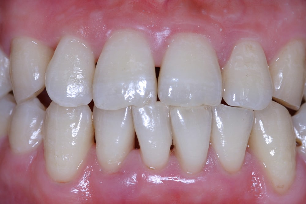 Gingivitis-after