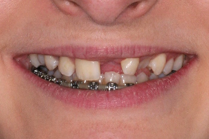 Multi-Disciplinary-braces-before