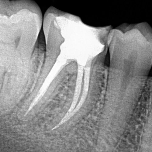 Root canal re-treatment after