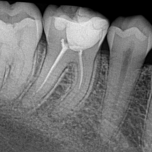 Root canal re-treatment Before