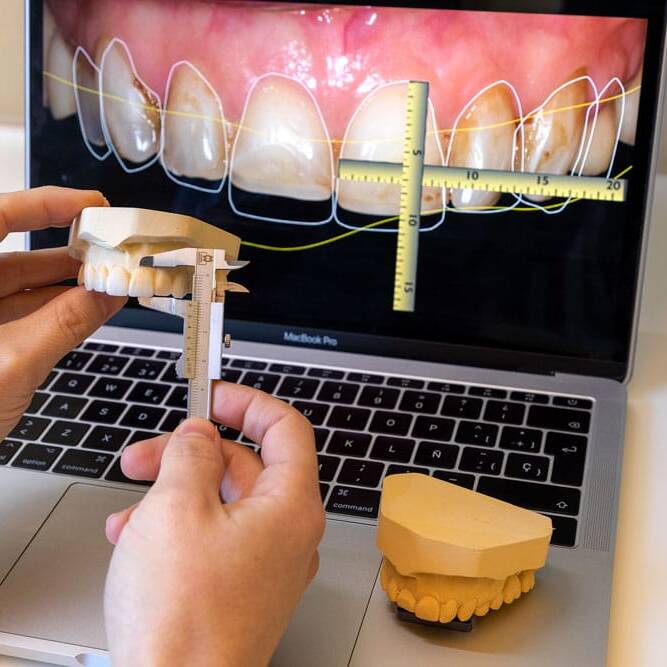 Advanced Dental Smile Design 2 Wax mock-up of veneers on dental models used for previewing final aesthetic results