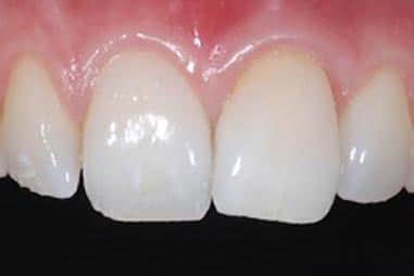 Tooth-whitening-single-after