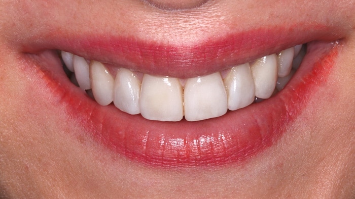 Veneers-after