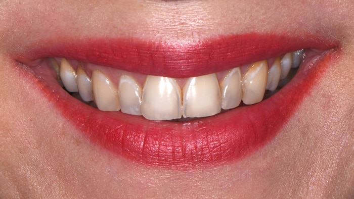 Veneers-before