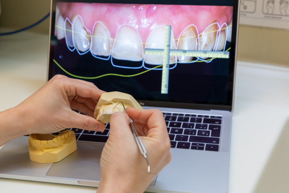 Bonded Composite Restorations Repairing Your Teeth