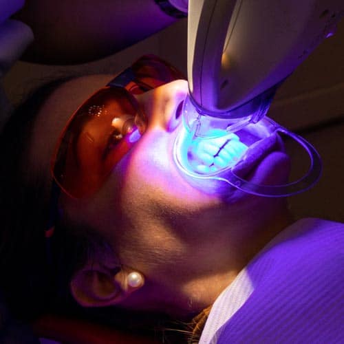 Teeth Whitening