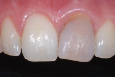 tooth-whitening-single-before