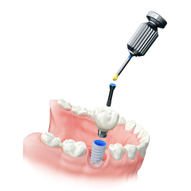 Dental Implant Process 3 3D illustration of a dental implant being inserted into the lower jaw with attached crown for final restoration