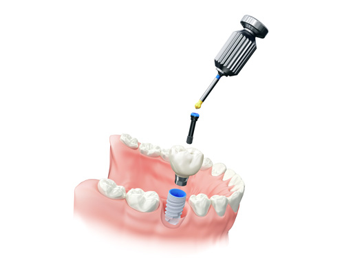 Dental Implant Process