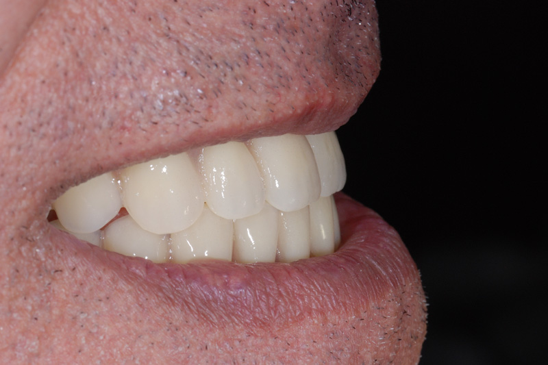 Teeth after orthodontic realignment