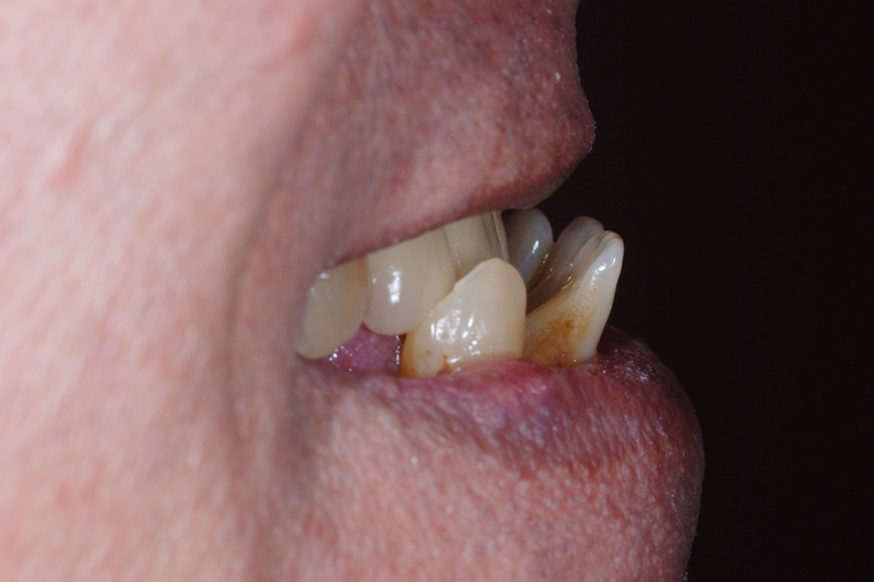 side view of badly aligned teeth