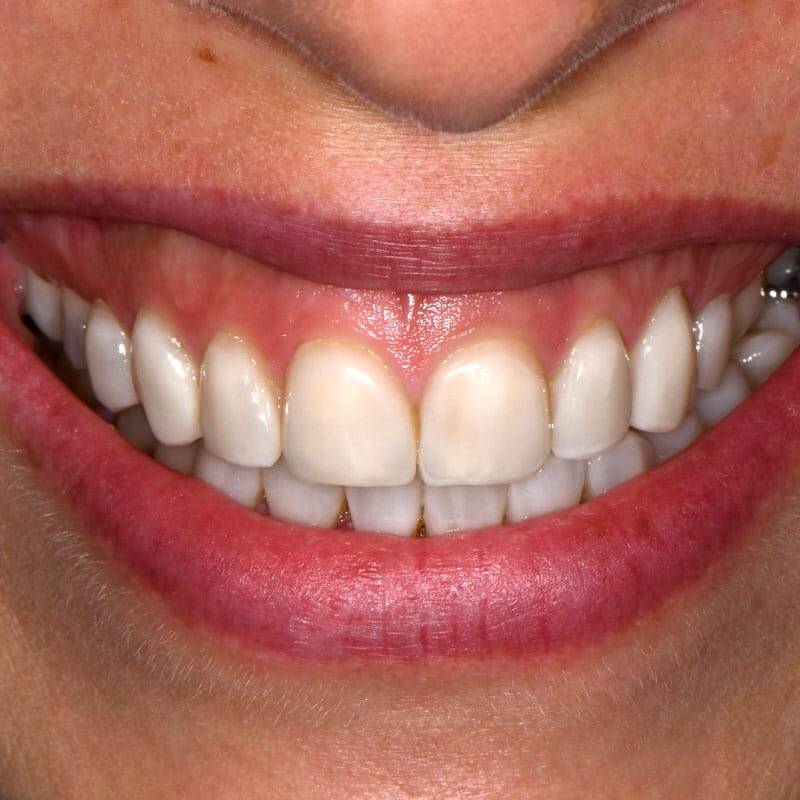 Veneer Big Smile uai