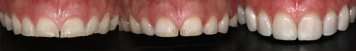 Porcelain Veneer treatment process