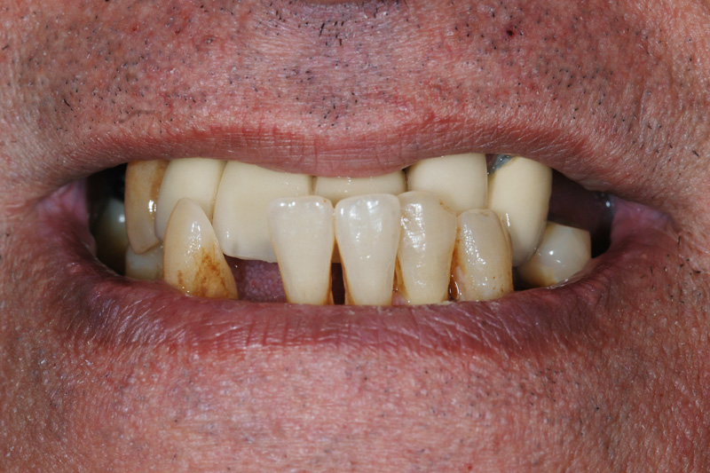 badly aligned teeth