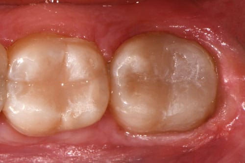 Dental Filling