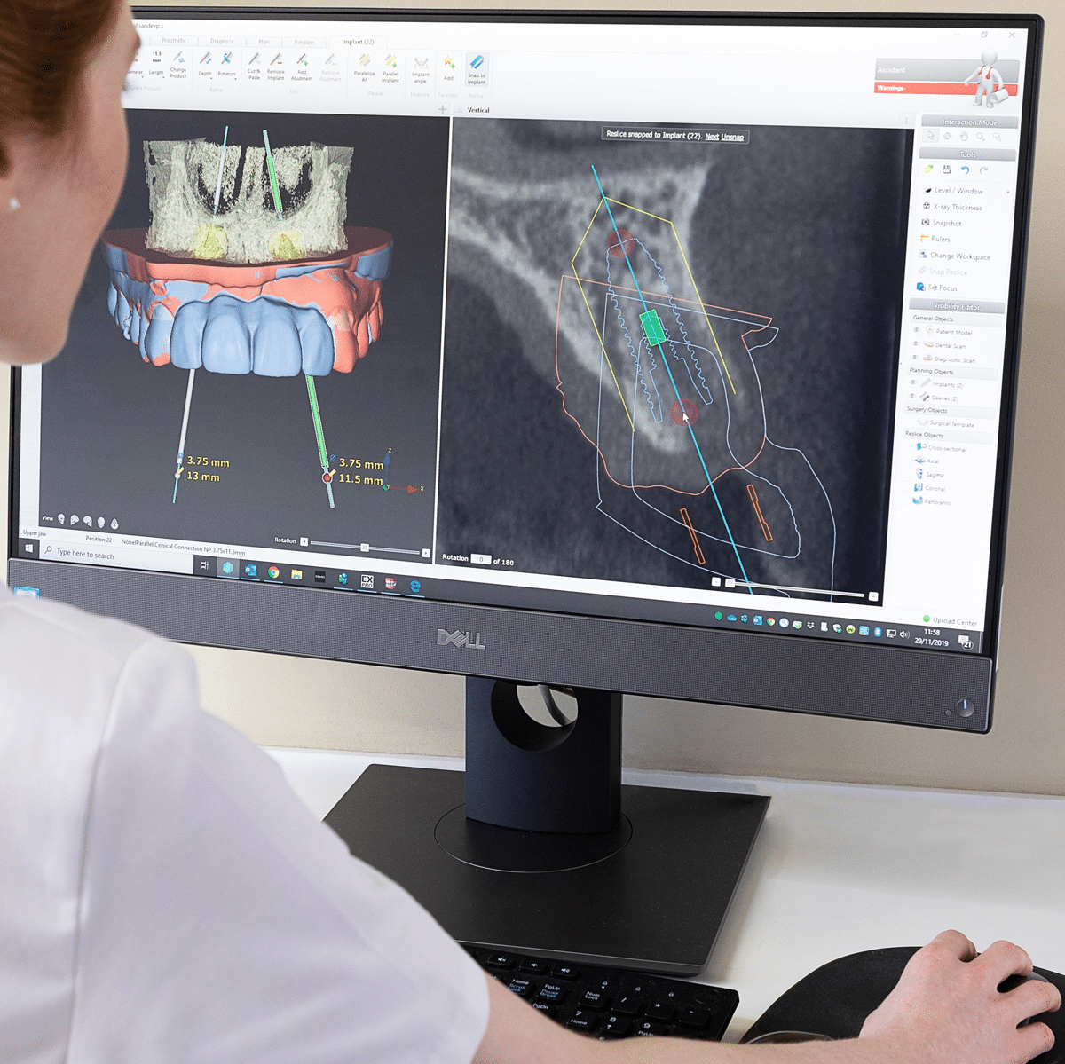 Dental-Implant-Planning-Digital-Dentistry 2 Dental Implant planning with digital dentistry on Wimpole Street in London