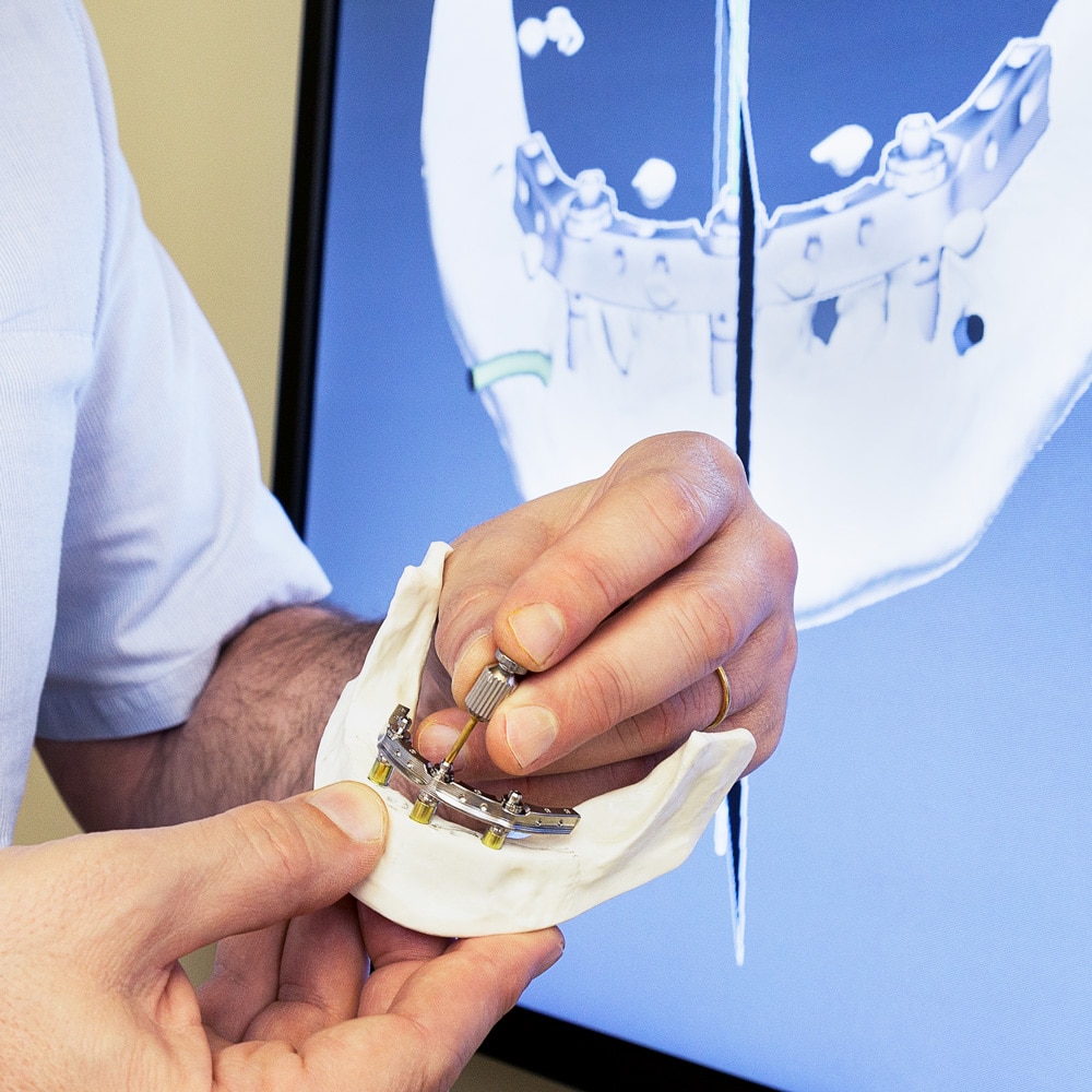 Dental Implants Less Cost Trefoil