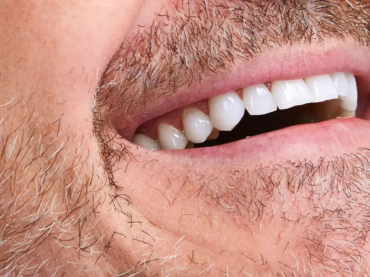Close-up of a man's bright white smile after whitening treatment