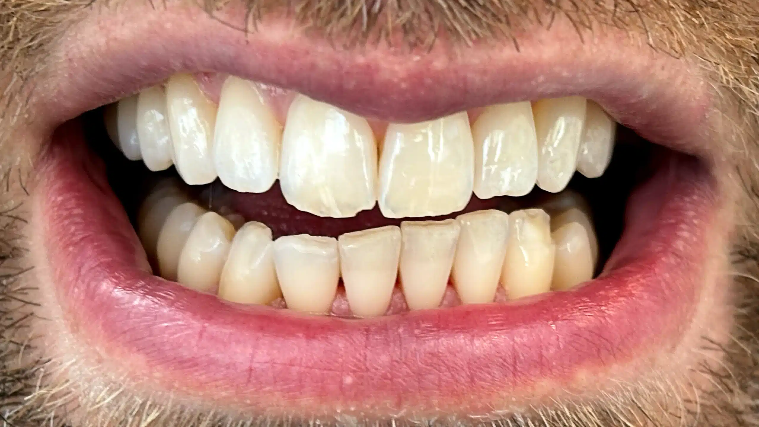 Before-and-after comparison of upper front teeth showing visible whitening improvement after treatment by Agnieszka Boultbee