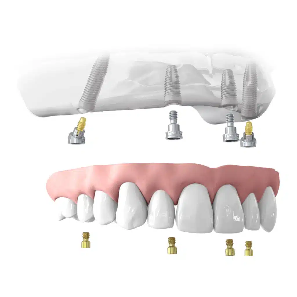 Diagram showing all-on-4 dental implants supporting a full upper denture in an All-on-4 configuration